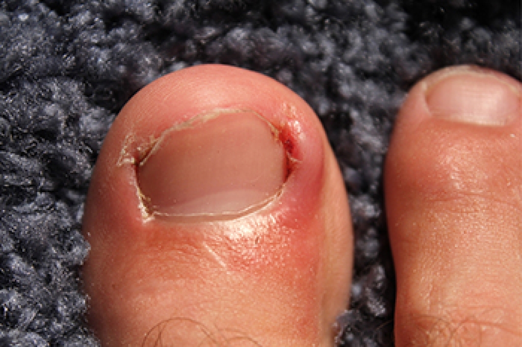 Ingrown Toenails and Podiatry Care