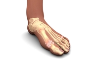 Understanding Gout Symptoms