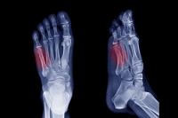 Comparing Types of Jones Fractures